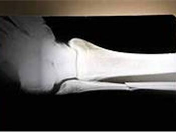 Micah On The Mend - Windsurfing News